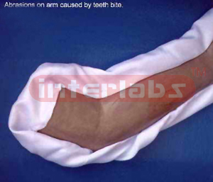 Abrasion on arm caused by teeth bite